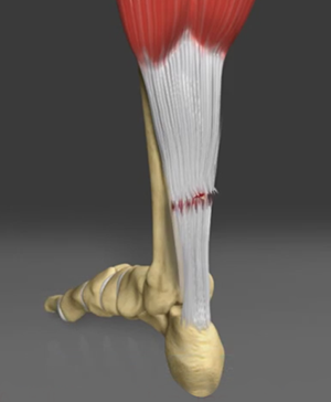 Achilles Tendon Repair