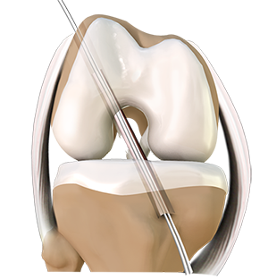 ACL Reconstruction 