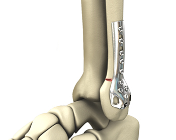 Ankle Fracture