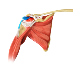 Rotator cuff tear