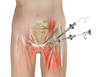 Hip Arthroscopy